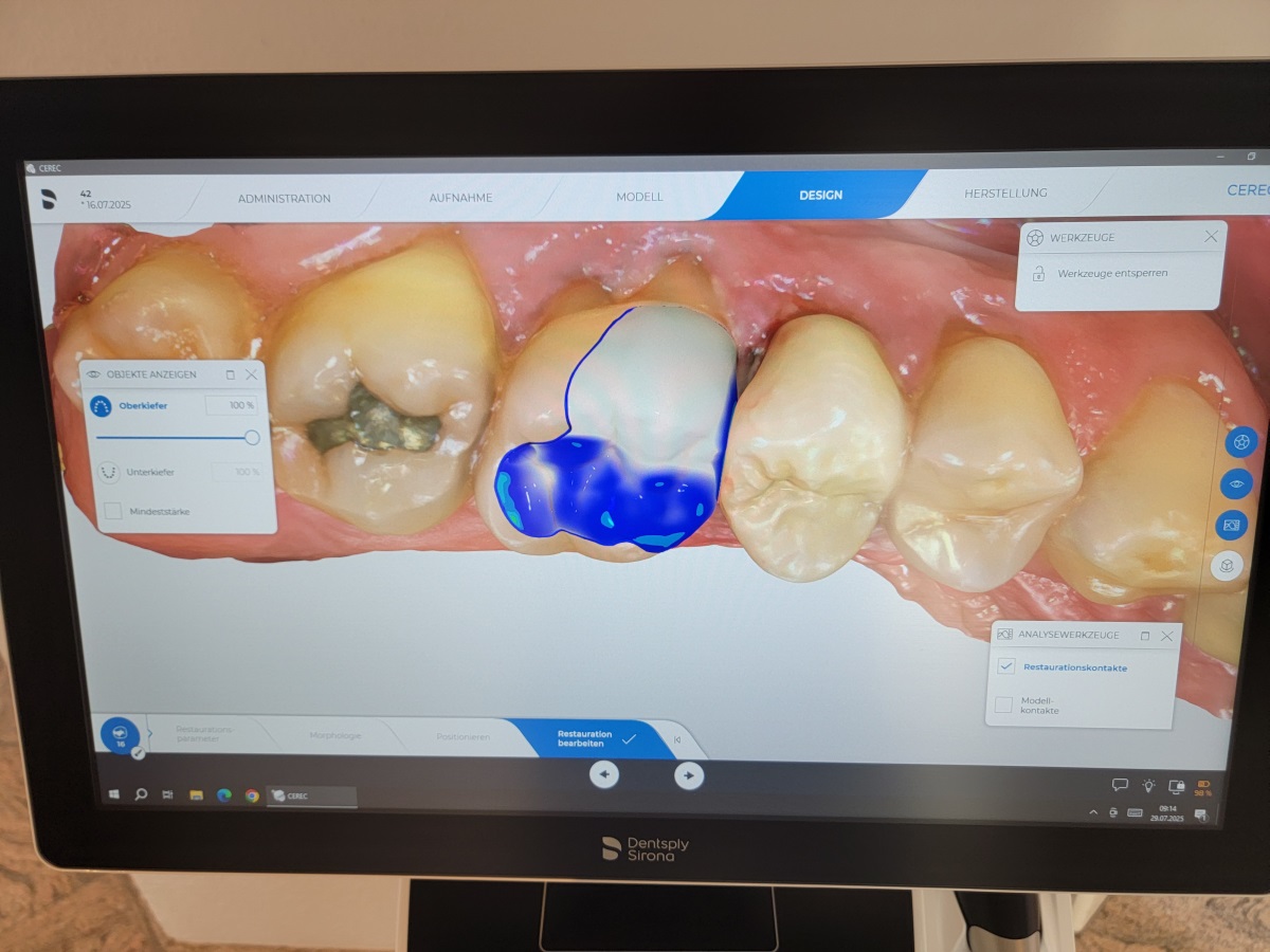 Computergestützte Herstellung von Kronen und Inlays